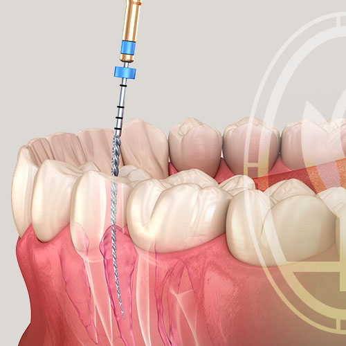 ENDODONTIA