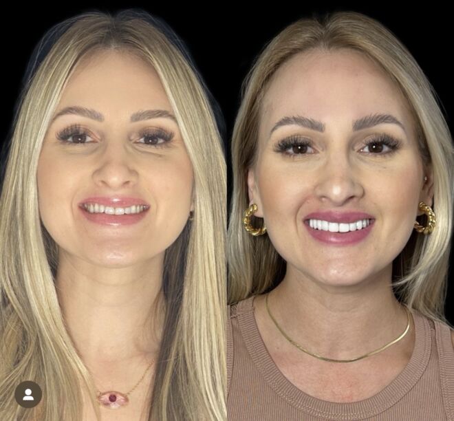 Facetas em resina_(1)